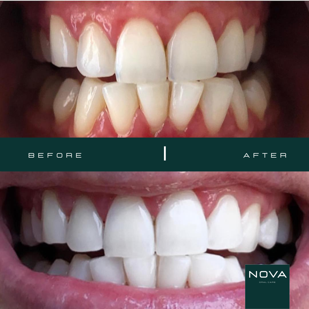 Original LED Dental Bleaching Kit - Nova® Oral Care | At-Home Teeth Whitening
