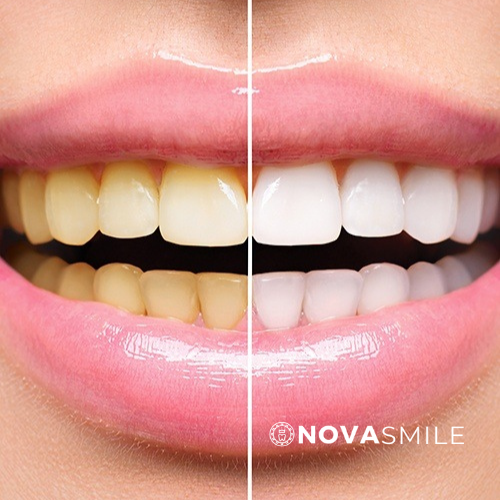 Beautiful South African female showing her smile makeover before and after using NovaSmile Premium Teeth Whitening kit Gel refill